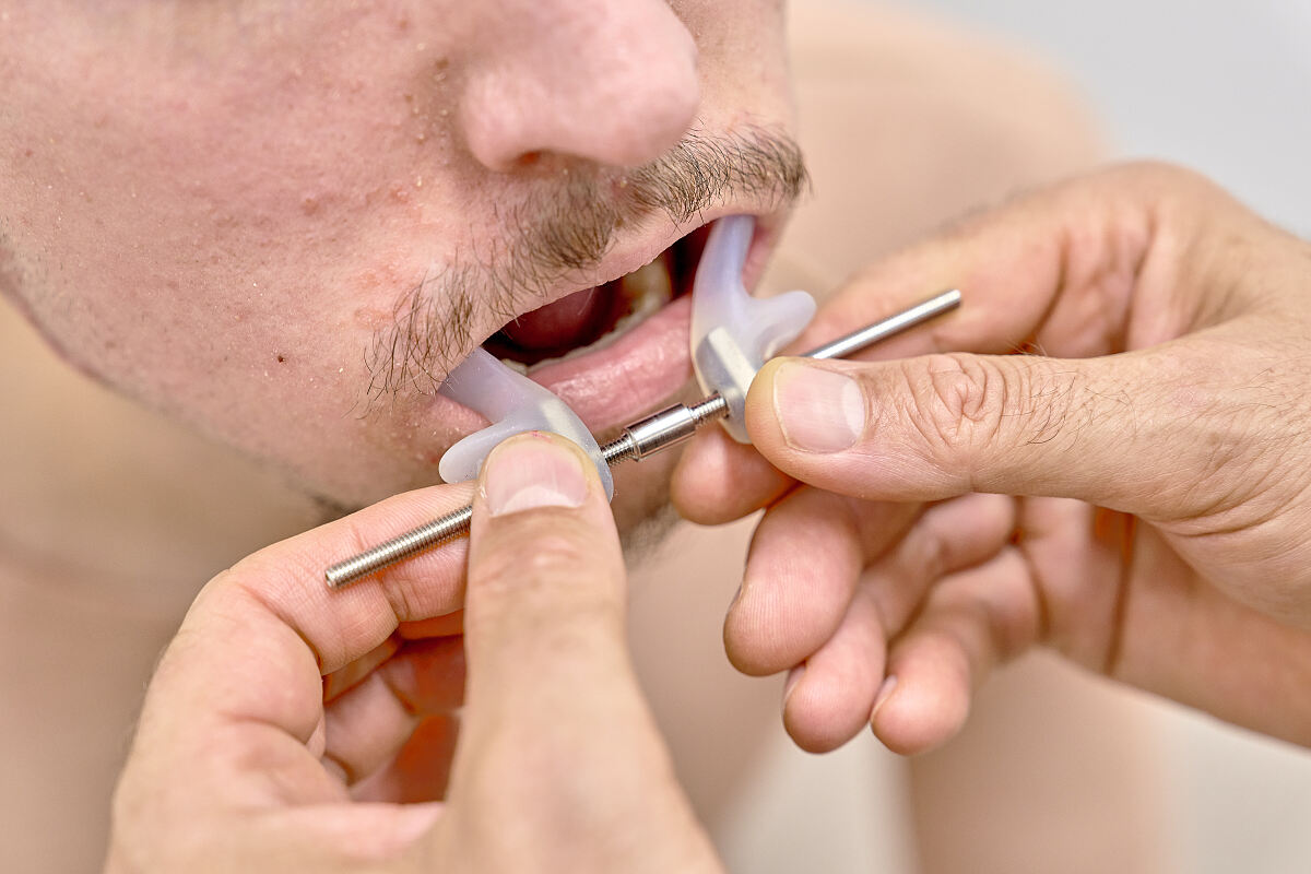 Ecarteur buccal  Mundspreizer